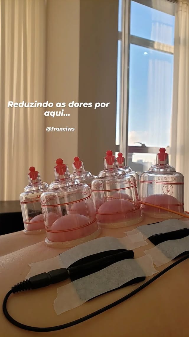 Atendimento com ventosaterapia